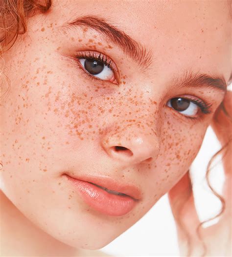 Everything You Need To Know About Hyperpigmentation