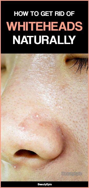 How To Get Rid Of Whiteheads Naturally At Home How To Get Rid Of