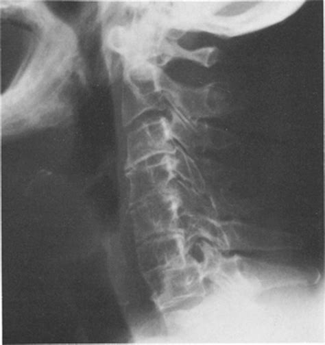 Complete Fracture Dislocation Of Cervical Spine Without Permanent