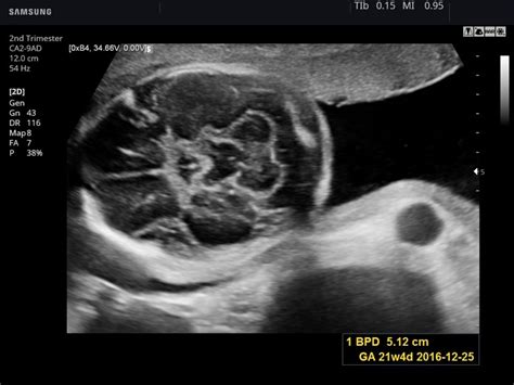 Ultrasound Images • Fetal Brain B Mode Echogramm №783