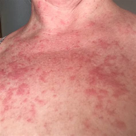 6 Details About Sun Allergy Polymorphic Or Polymorphous Light Eruption