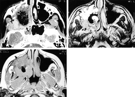 Synovial Sarcomas Of The Head And Neck Ct And Mr Imaging Findings Of