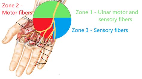 What Do You Expect With An Ulnar Nerve Injury Emg Solutions