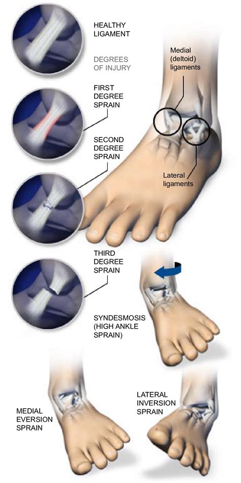 Ankle Sprains Orthopaedic Associates Of Riverside