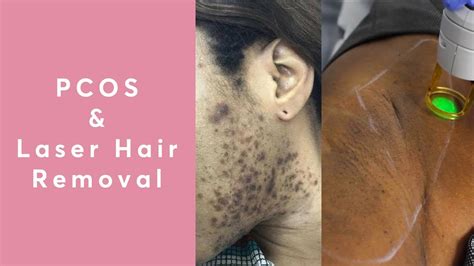 Does Laser Hair Removal Work For Pcos Youtube
