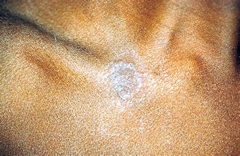 Tinea Corporis Toronto Notes