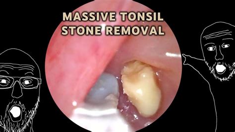 Multitude Of Massive Tonsil Stones Removed Aim 20 Youtube