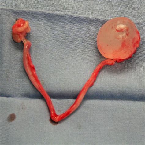 Uterine leiomyomas also referred to as uterine fibroids, are benign tumors of myometrial origin and are the most common solid benign uterine neoplasms. http://www.pcos-treatment.net/cysts-on-ovaries.html An ...