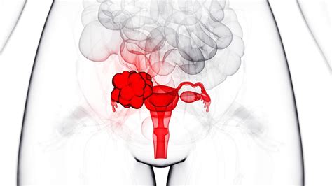 Irregular Periods Could Boost Ovarian Cancer Risk Science Aaas