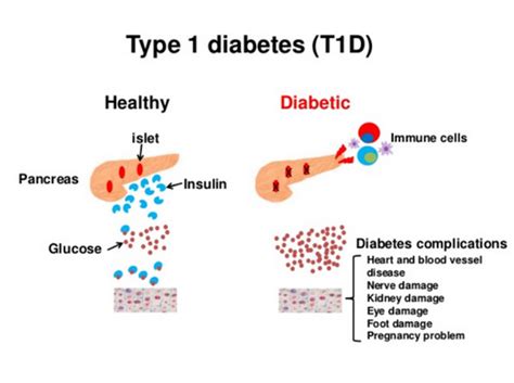 Can Type 2 Diabetes Develop Into Type 1 - DiabetesWalls