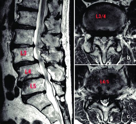 Foraminal Stenosis Lumbar Spinal Mri