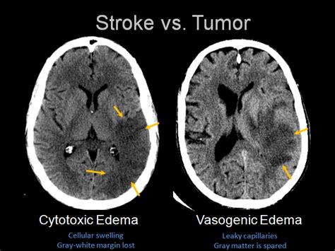 Vasogenic oedema: grey-white matter differentiation is ...