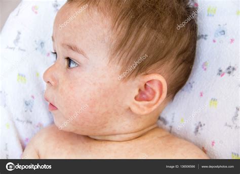 Newborn Baby Acne Or Rash Newborn Baby