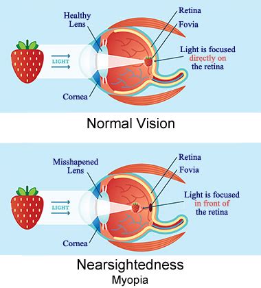 Maybe you would like to learn more about one of these? Nearsighted (Myopia) - First Eye Care Downtown Dallas