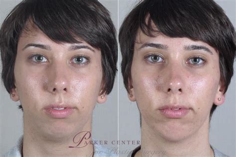 Cheekchin Implants Before And After Pictures Case 254 Paramus Nj