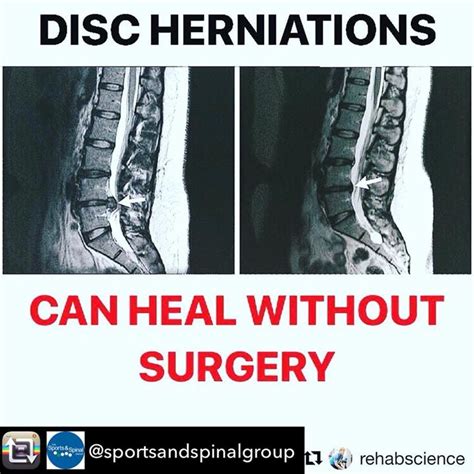Repost From Sportsandspinalgroup Can Discs Heal ・・・ Disc Healing