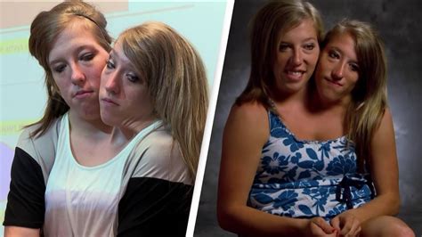Conjoined Twins Opened Up On What Their Life Was Like After Becoming