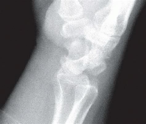 Perilunate Dislocation Radiology Key