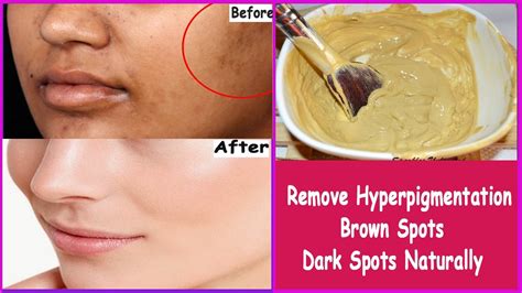 Simple And Easy Home Remedies To Reduce Hyperpigmentation Brown Spots