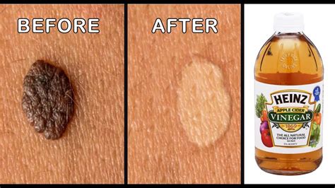 Mole Removal By Apple Cider Vinegar Effective Ways To Remove Skin