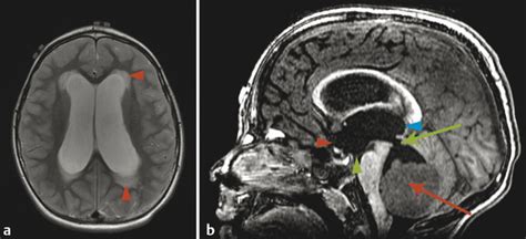 11 Hydrocephalus Radiology Key