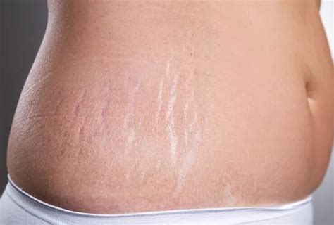 ما الذي يسبب علامات تمدد الجلد وكيفية التخلص منها أحلى هاوم