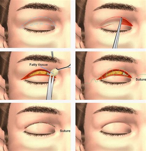 Upper Blepharoplasty Procedure For The Lower Eyelids Cosmetic Surgery Mexico Cosmetic