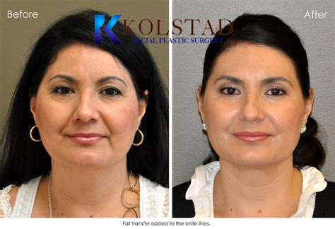 Dr Kolstad San Diego Facial Plastic Surgeon