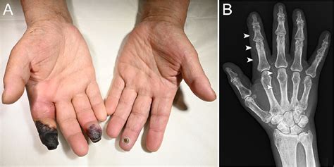 A Diabetic Patient With Finger Gangrene European Journal Of Internal
