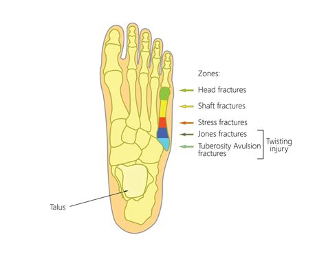 Strash Foot Ankle Care What Are Fifth Metatarsal Fractures