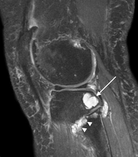 Mri Features Of Cystic Lesions Around The Knee The Knee