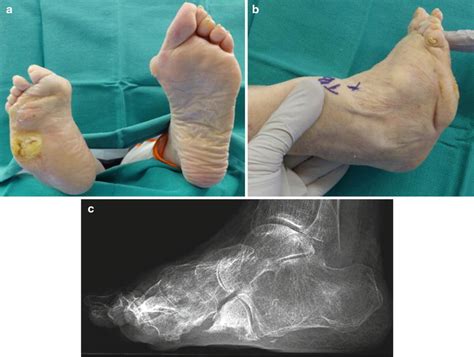 Choparts Amputation For Osteomyelitis Of The Midfoot Musculoskeletal Key