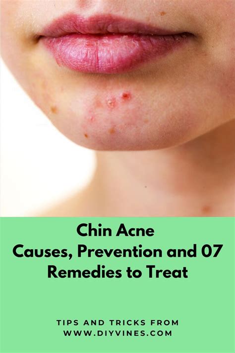 What Causes Chin Acne In Females