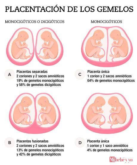 Gemelos Infografia En 2023 Síntomas De Embarazo Embarazo De Gemelos
