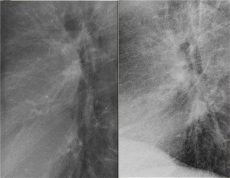 Previous Normal Chest X Ray Left And Chf Stage Ii Grepmed