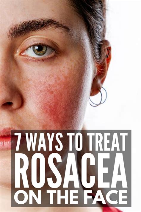 How To Get Rid Of Rosacea 7 Rosacea Remedies That Work In 2021