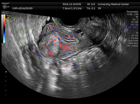 vaginal ultrasound showing atrophy of the uterus and ovaries hot sex picture