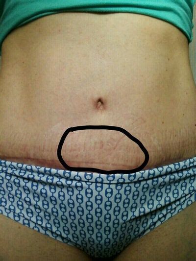 Fluids in the gut then increase, causing muscle contractions in the gut to increase. Small Seroma at 12weeks? (photo) Doctor Answers, Tips