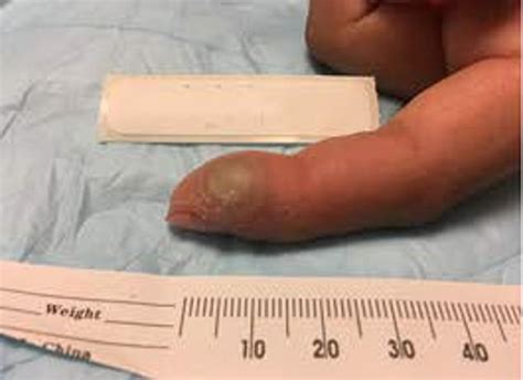 Lab Workers Finger Begins To Rot After She Injects Herself With A