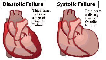 Systolic Vs Diastolic Heart Failure Astral Projection