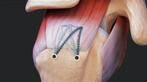 Knotless Fibertak Speedbridge Rotator Cuff Repair With Medial Pulley