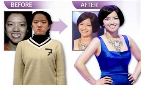 Mind Blowing Before And After Faces From South Korea S Plastic