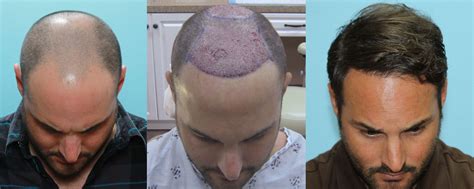 Fue Hair Transplant Case Study Year Before After