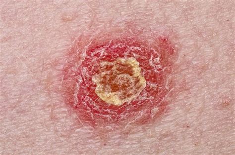 Guttate Psoriasis On The Skin Stock Image C0169273 Science Photo