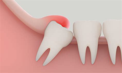 Pericoronitis And Your Wisdom Teeth — Paramount Dental Sydney
