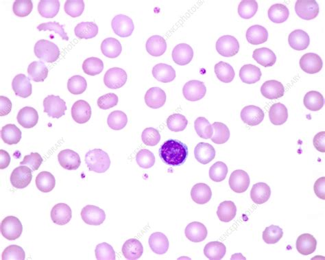 Human Blood Smear With Lymphocyte Light Micrograph Stock Image