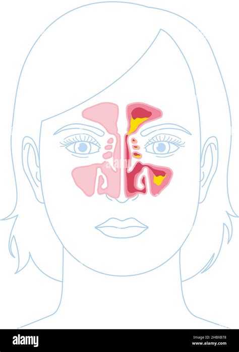 Vector Illustration Showing Healthy Sinus And Sinusitis With Inflamed