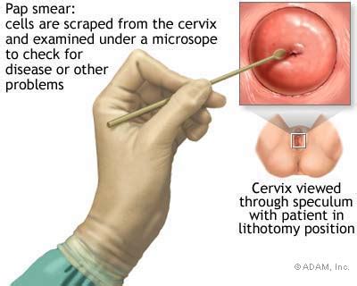 Pap Smear Diagnosis And Screening Pap Smear Health Information NY