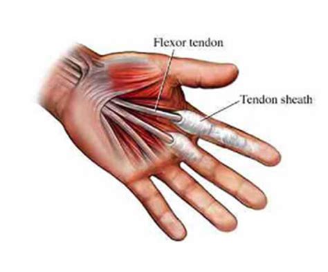 Tendon Injuries Repair South Florida Hand Surgery