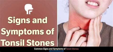 Tonsil Stones Symptoms 9 Common Symptoms Of Tonsil Stones
